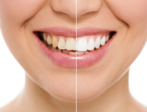 Five Things You Should Know about Teeth Whitening