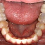 Porcelain crown supported by implant