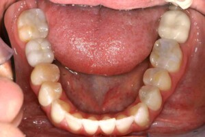 Porcelain crown supported by implant