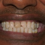 Before treatment for full mouth reconstruction