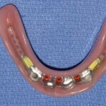 bar overdenture bar denture – 2
