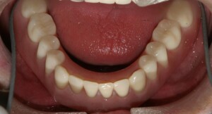 bar overdenture bar denture