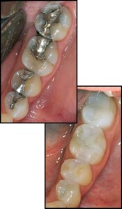 Change out unattractive metal fillings with white-colored fillings from Ingenious Dentistry. 