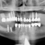 implant-pano-after1