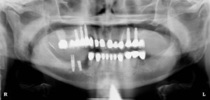 implant-pano-after1