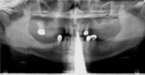 implant-pano-before1
