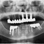 implant7b