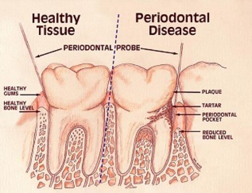 What Causes Chronic Gum Disease?