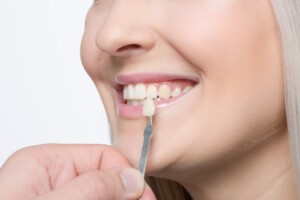 Using shade guide at woman’s mouth to check veneer of tooth crown