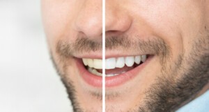 Dental care and whitening teeth compare