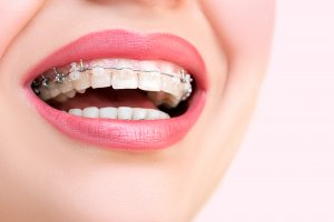 ceramic braces to straighten teeth_ingenious dentistry