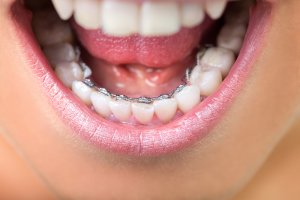 lingual braces teeth straightening_ingenious dentistry
