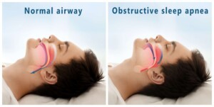 Airway Management with Vivos Treatment in Houston, TX | Ingenious Dentistry