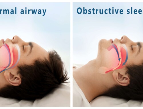 Airway Management with Vivos Treatment in Houston, TX