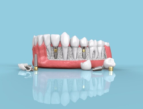 Why You Should You Consider Dental Implants