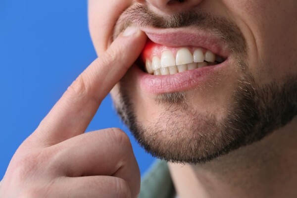 man showing swollen gum abscess